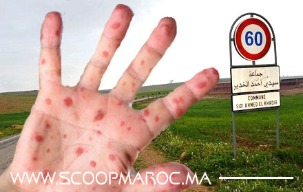 إقليم سطات: "الحميدي" يستنكر التفاعل السطحي مع بوحمرون بسيدي أحمد الخدير ومندوب الصحة يتدخل لحلحلة الموضوع