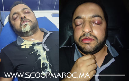 ناشط فايسبوكي بسطات يدخل الإنعاش متأثرا بتداعيات اعتداء جسدي جماعي وأصابع الاتهام تتجه إلى مستشارة جماعية